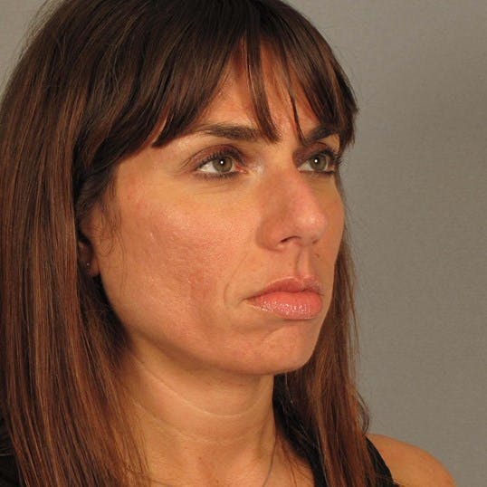 Rhinoplasty Before & After Gallery - Patient 251715 - Image 5