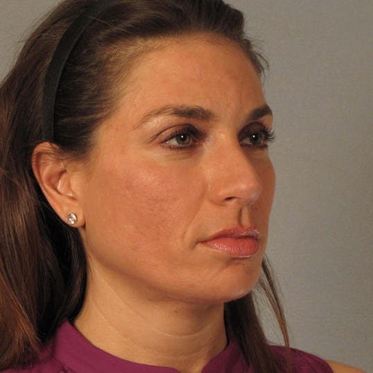 Rhinoplasty Before & After Gallery - Patient 251715 - Image 6
