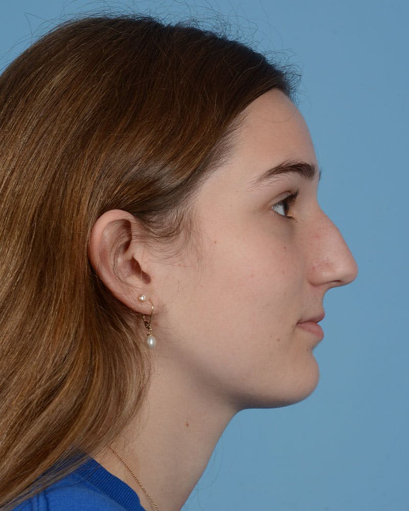 Rhinoplasty Before & After Gallery - Patient 358357 - Image 1