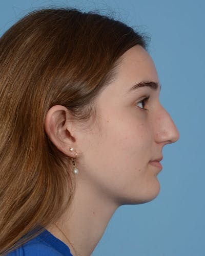 Rhinoplasty Before & After Gallery - Patient 358357 - Image 1