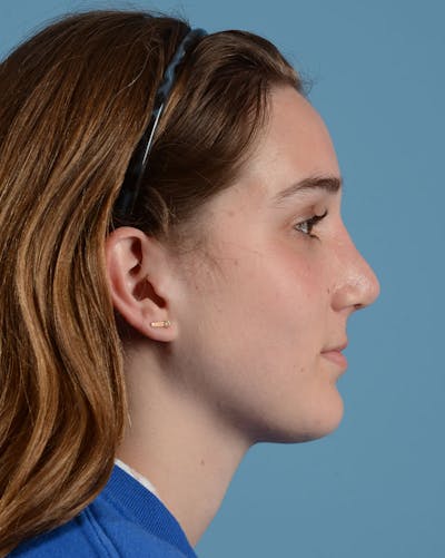 Rhinoplasty Before & After Gallery - Patient 358357 - Image 2