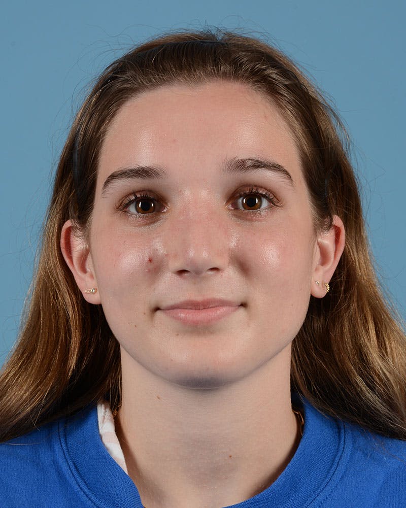 Rhinoplasty Before & After Gallery - Patient 358357 - Image 4