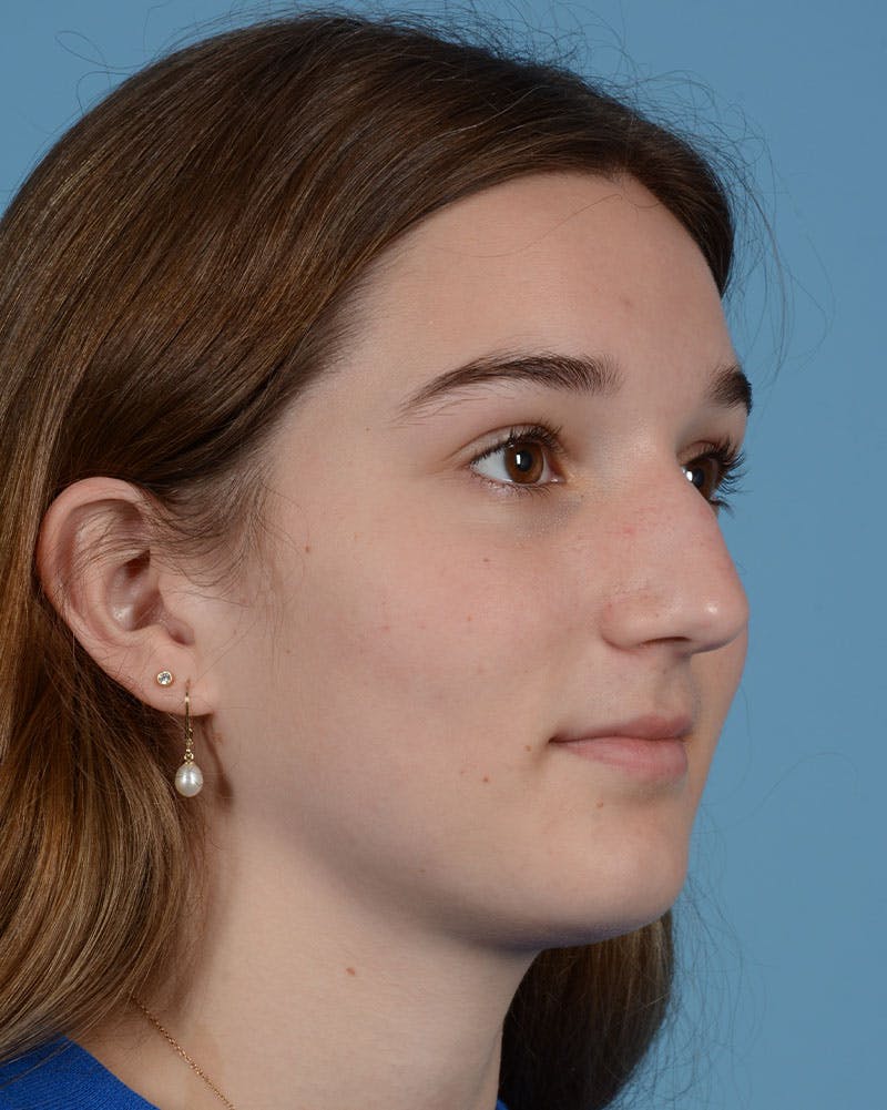 Rhinoplasty Before & After Gallery - Patient 358357 - Image 5