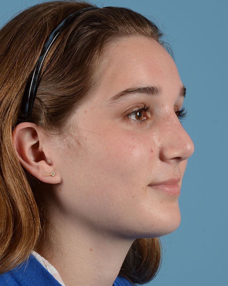 Rhinoplasty Before & After Gallery - Patient 358357 - Image 6
