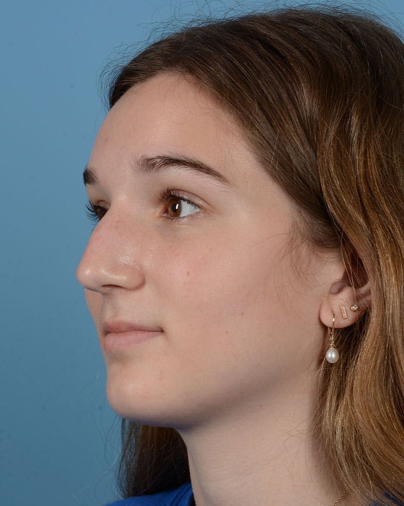 Rhinoplasty Before & After Gallery - Patient 358357 - Image 7