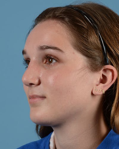 Rhinoplasty Before & After Gallery - Patient 358357 - Image 8