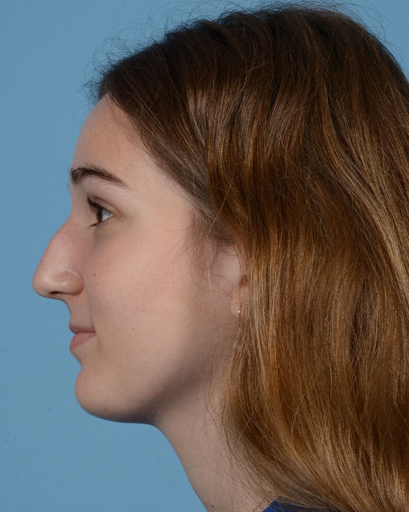 Rhinoplasty Before & After Gallery - Patient 358357 - Image 9