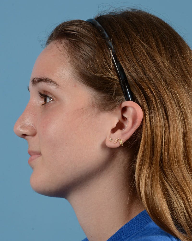 Rhinoplasty Before & After Gallery - Patient 358357 - Image 10