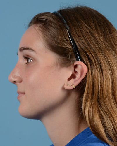 Rhinoplasty Before & After Gallery - Patient 358357 - Image 10