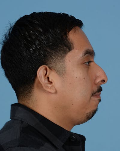 Rhinoplasty Before & After Gallery - Patient 151405 - Image 1