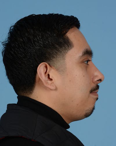 Rhinoplasty Before & After Gallery - Patient 151405 - Image 2