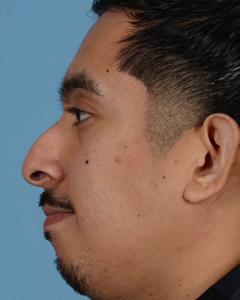 Rhinoplasty Before & After Gallery - Patient 151405 - Image 3