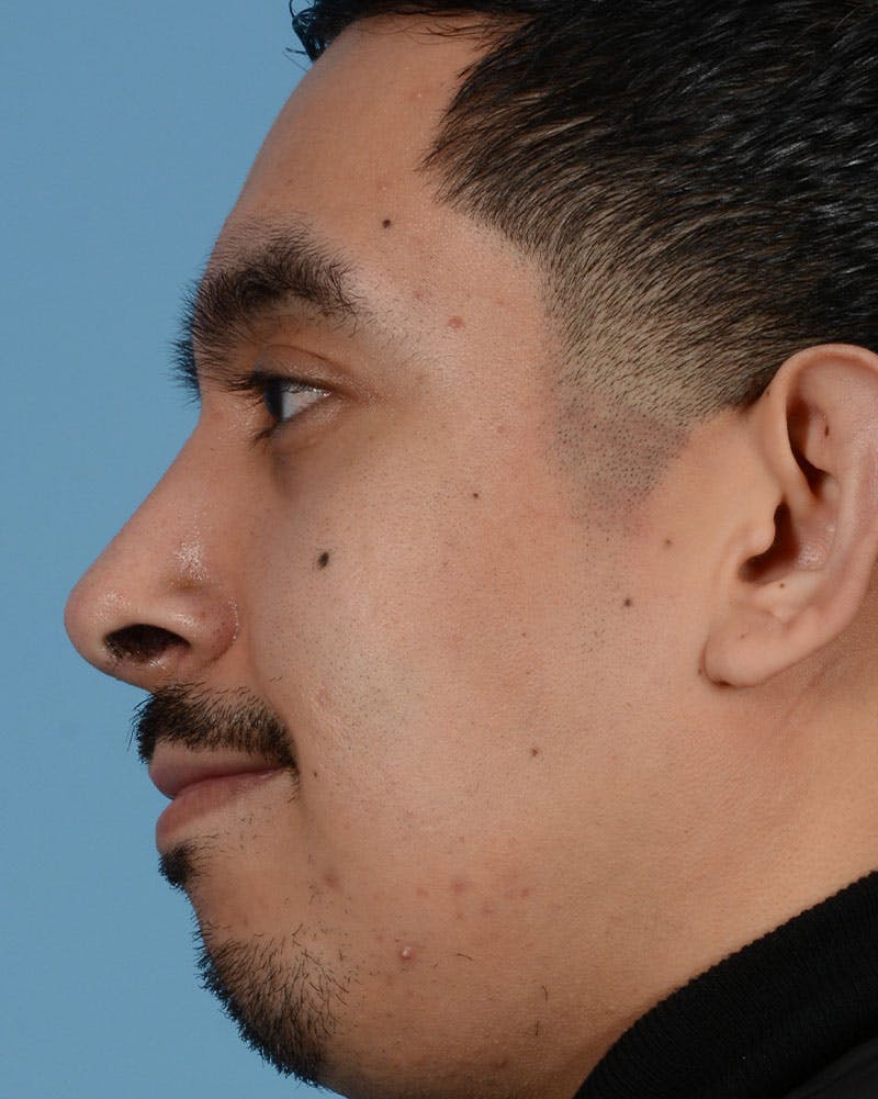 Rhinoplasty Before & After Gallery - Patient 151405 - Image 4