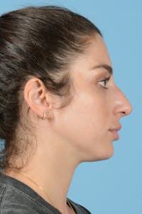 Rhinoplasty Before & After Gallery - Patient 238024 - Image 1
