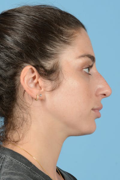 Rhinoplasty Before & After Gallery - Patient 238024 - Image 1