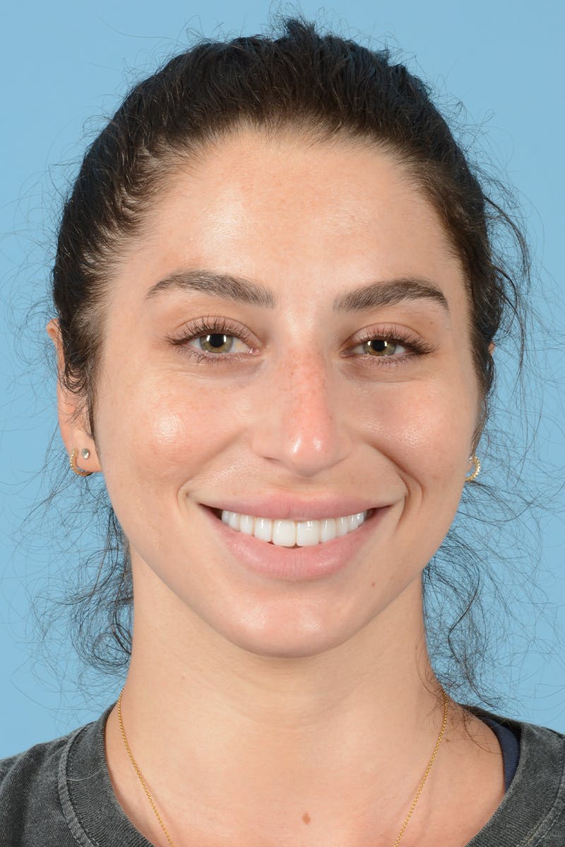 Rhinoplasty Before & After Gallery - Patient 238024 - Image 5