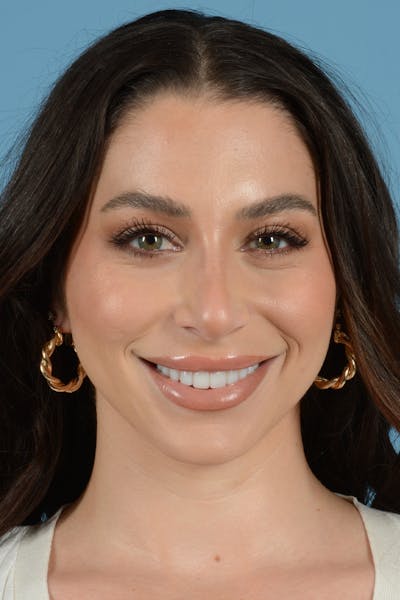 Rhinoplasty Before & After Gallery - Patient 238024 - Image 6