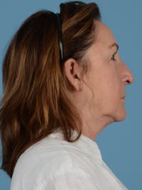 Rhinoplasty Before & After Gallery - Patient 153931 - Image 1