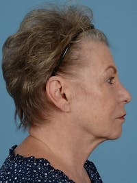 Rhinoplasty Before & After Gallery - Patient 139772 - Image 1