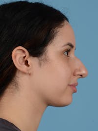 Rhinoplasty Before & After Gallery - Patient 406532 - Image 1