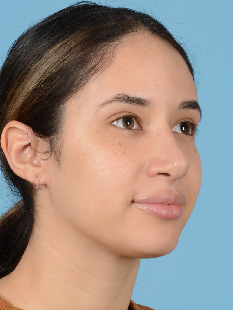 Rhinoplasty Before & After Gallery - Patient 406532 - Image 4