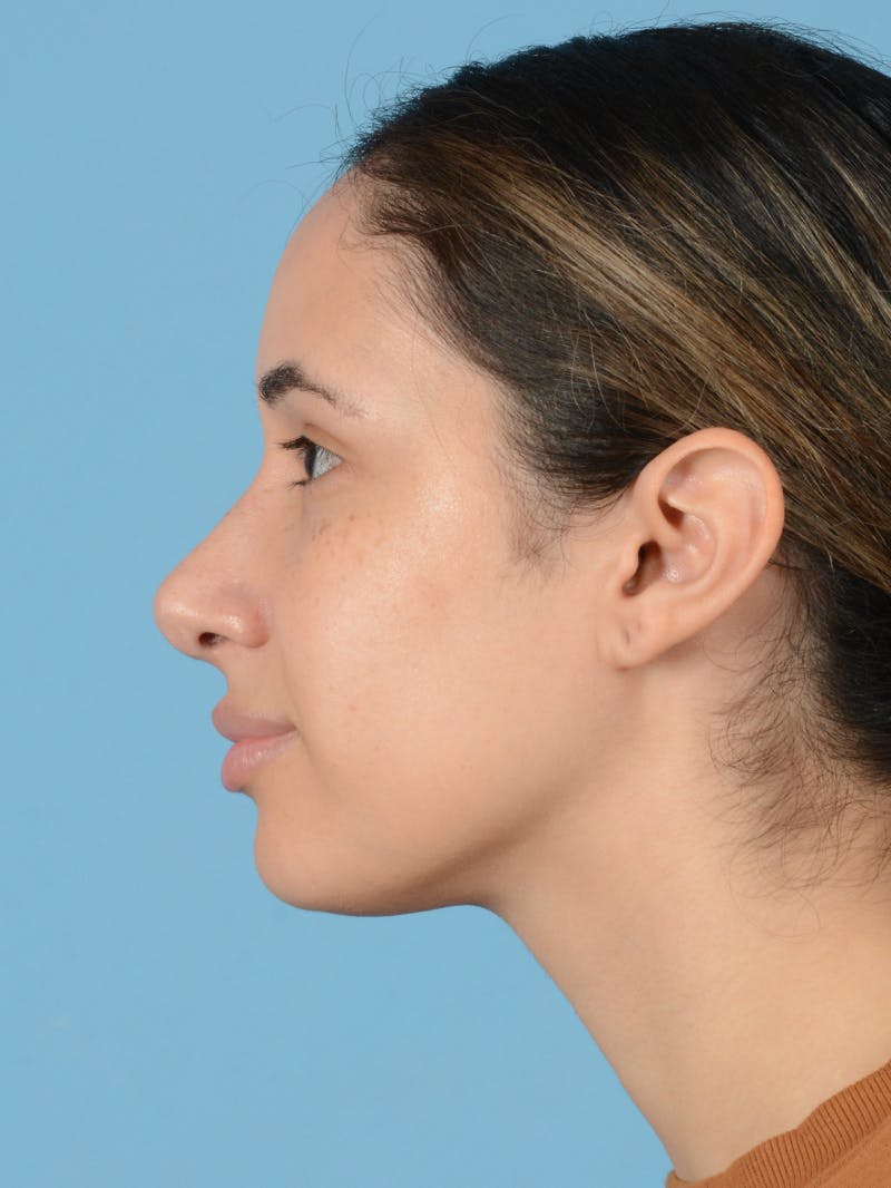 Rhinoplasty Before & After Gallery - Patient 406532 - Image 6