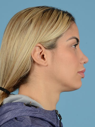 Rhinoplasty Before & After Gallery - Patient 211774 - Image 2