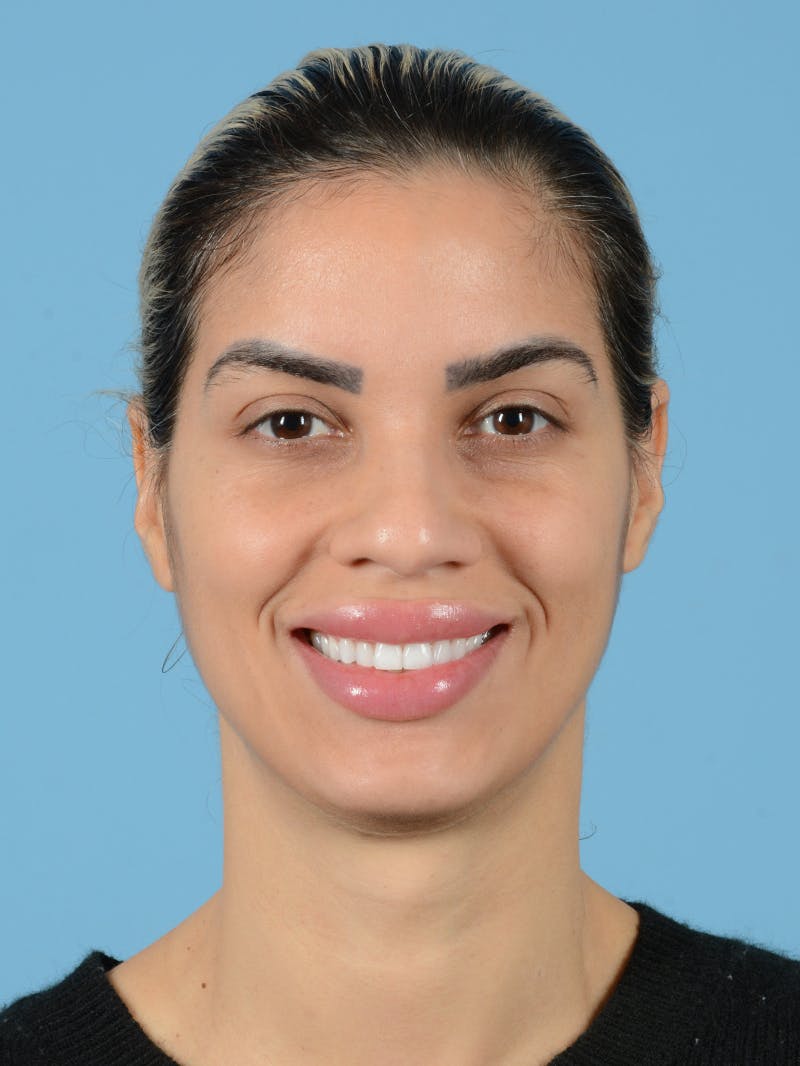 Rhinoplasty Before & After Gallery - Patient 211774 - Image 7