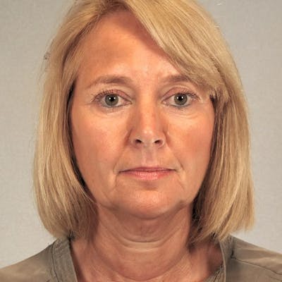 Facelift Before & After Gallery - Patient 421354 - Image 1