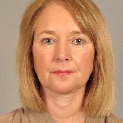 Facelift Before & After Gallery - Patient 421354 - Image 2