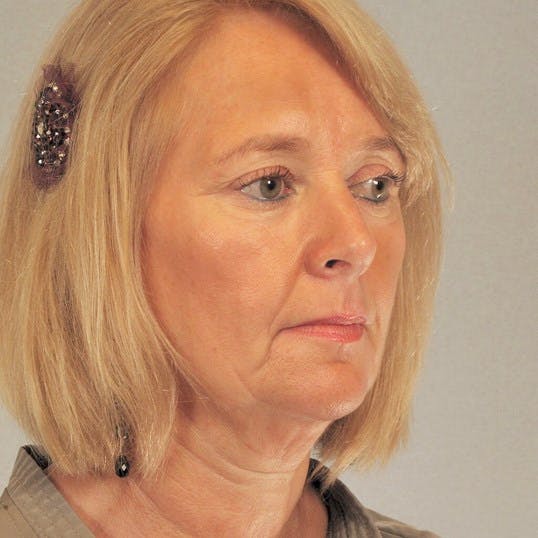 Facelift Before & After Gallery - Patient 421354 - Image 3
