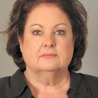 Facelift Before & After Gallery - Patient 424389 - Image 1