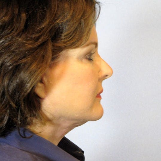 Facelift Before & After Gallery - Patient 424389 - Image 6