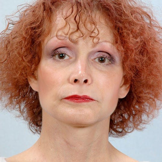Facelift Before & After Gallery - Patient 427524 - Image 2