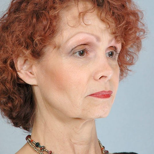 Facelift Before & After Gallery - Patient 427524 - Image 3