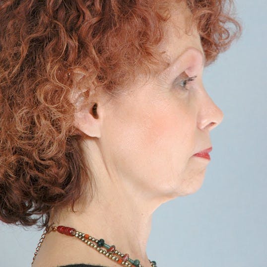 Facelift Before & After Gallery - Patient 427524 - Image 5