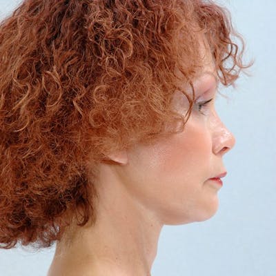 Facelift Before & After Gallery - Patient 427524 - Image 6