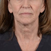 Facelift Before & After Gallery - Patient 353540 - Image 1