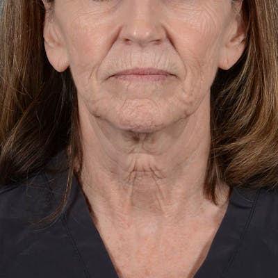 Facelift Before & After Gallery - Patient 353540 - Image 1