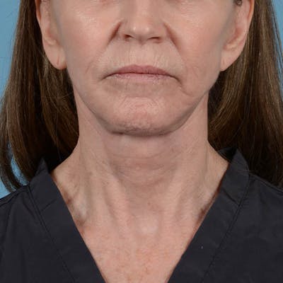 Facelift Before & After Gallery - Patient 353540 - Image 2