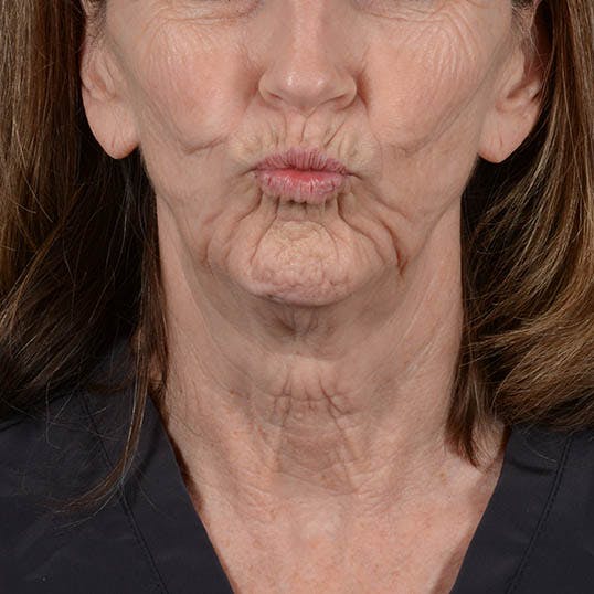 Facelift Before & After Gallery - Patient 353540 - Image 3