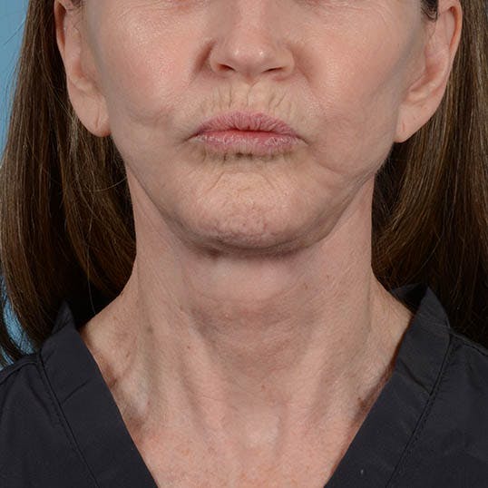 Facelift Before & After Gallery - Patient 353540 - Image 4