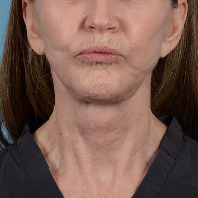 Facelift Before & After Gallery - Patient 353540 - Image 4