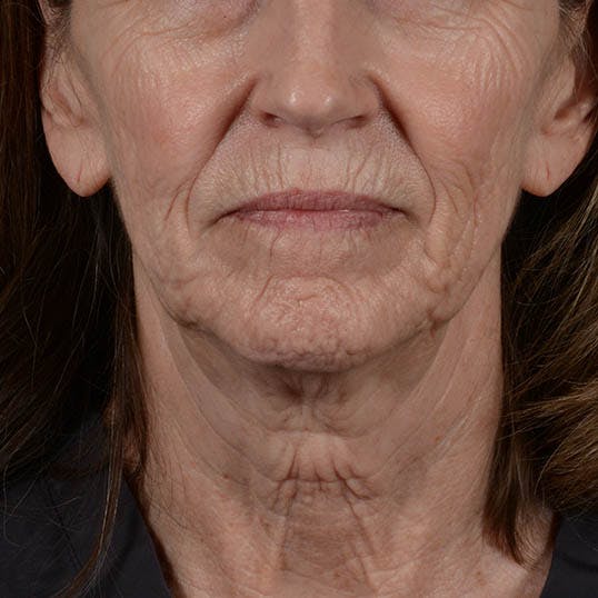 Facelift Before & After Gallery - Patient 353540 - Image 5