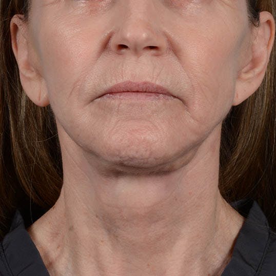 Facelift Before & After Gallery - Patient 353540 - Image 6
