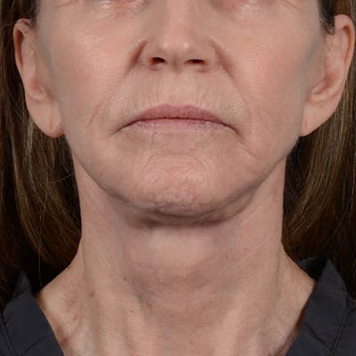 Facelift Before & After Gallery - Patient 353540 - Image 6