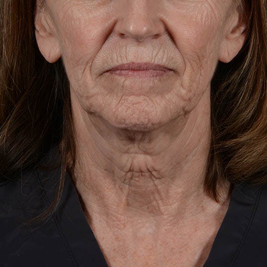 Facelift Before & After Gallery - Patient 353540 - Image 7