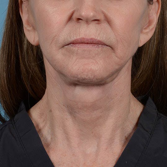 Facelift Before & After Gallery - Patient 353540 - Image 8