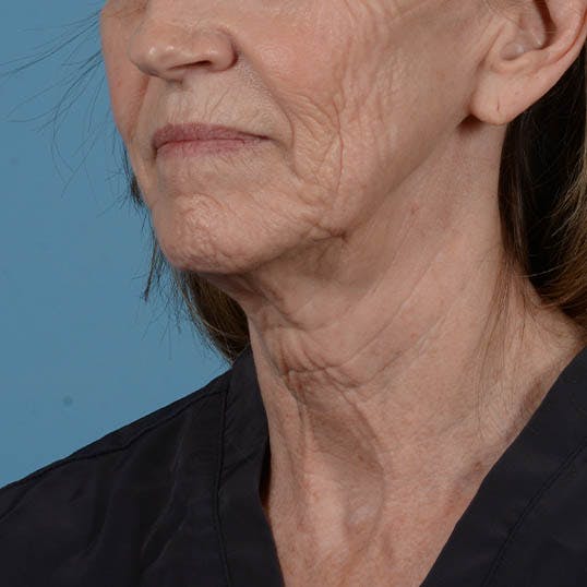 Facelift Before & After Gallery - Patient 353540 - Image 9