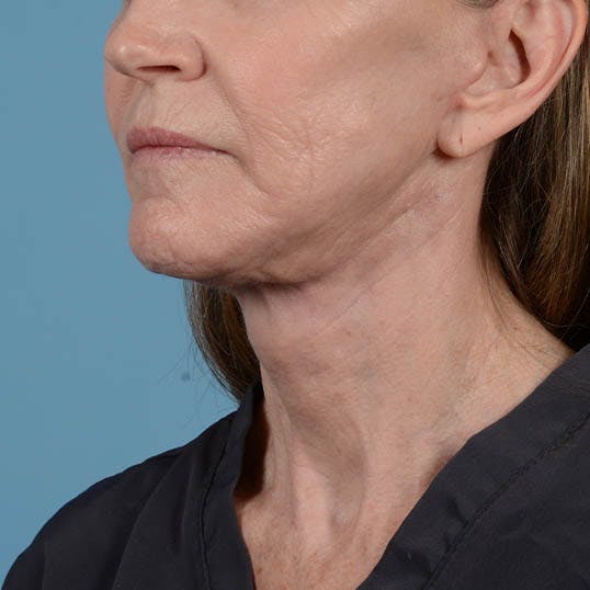 Facelift Before & After Gallery - Patient 353540 - Image 10